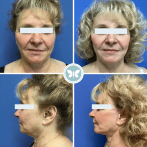 before and after of monarch mini facelift performed by Dr. Bene