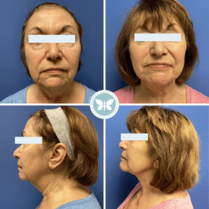 Before and after image of Monarch Mini Facelift showing beautiful change in neck, chin, cheek area.