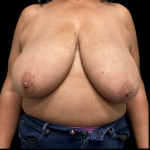 Breast Reduction Before & After Patient #1499