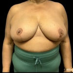 Breast Reduction Before & After Patient #1499