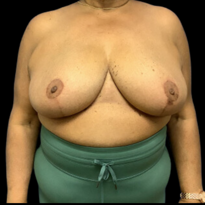 Breast Reduction Before & After Patient #1499