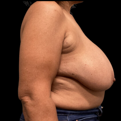 Breast Reduction Before & After Patient #1499