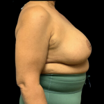 Breast Reduction Before & After Patient #1499
