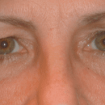 Blepharoplasty Before & After Patient #1809