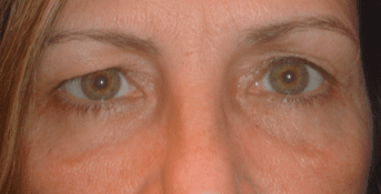 Blepharoplasty Before & After Patient #1809