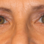 Blepharoplasty Before & After Patient #1809