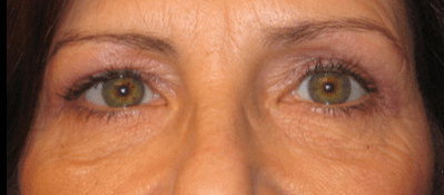 Blepharoplasty Before & After Patient #1809