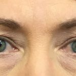 Blepharoplasty Before & After Patient #1812