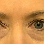 Blepharoplasty Before & After Patient #1812