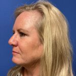 Blepharoplasty Before & After Patient #1815