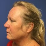 Blepharoplasty Before & After Patient #1815