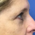Blepharoplasty Before & After Patient #1820