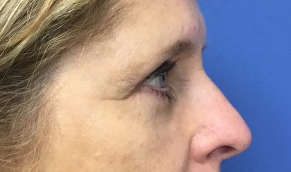 Blepharoplasty Before & After Patient #1820