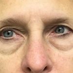 Blepharoplasty Before & After Patient #1820