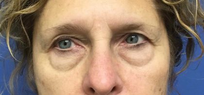 Blepharoplasty Before & After Patient #1820