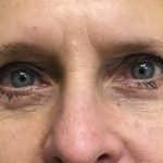 Blepharoplasty Before & After Patient #1820