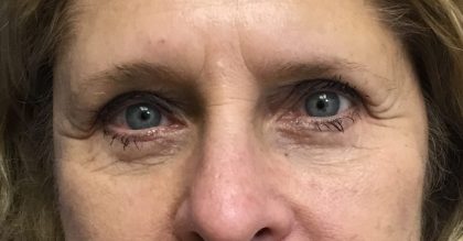 Blepharoplasty Before & After Patient #1820