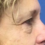 Blepharoplasty Before & After Patient #1820