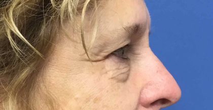 Blepharoplasty Before & After Patient #1820