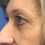 Blepharoplasty Before & After Patient #1825