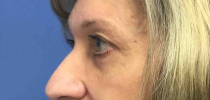Blepharoplasty Before & After Patient #1825