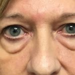 Blepharoplasty Before & After Patient #1825