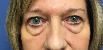 Blepharoplasty Before & After Patient #1825