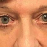 Blepharoplasty Before & After Patient #1825
