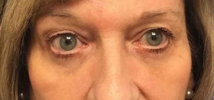 Blepharoplasty Before & After Patient #1825