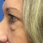 Blepharoplasty Before & After Patient #1825