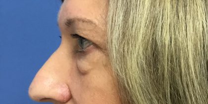 Blepharoplasty Before & After Patient #1825