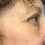 Blepharoplasty Before & After Patient #1830