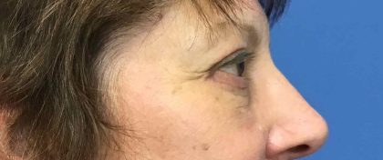 Blepharoplasty Before & After Patient #1830
