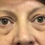 Blepharoplasty Before & After Patient #1830