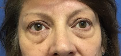 Blepharoplasty Before & After Patient #1830