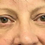 Blepharoplasty Before & After Patient #1830