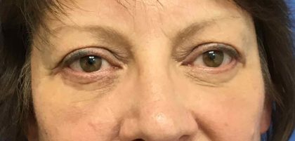 Blepharoplasty Before & After Patient #1830