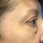Blepharoplasty Before & After Patient #1830