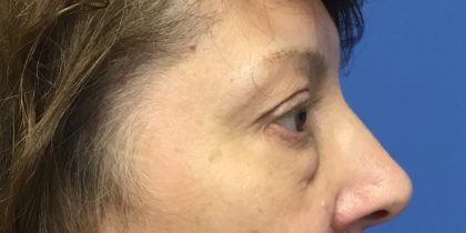 Blepharoplasty Before & After Patient #1830
