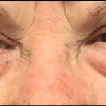 Blepharoplasty Before & After Patient #1835