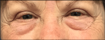 Blepharoplasty Before & After Patient #1835