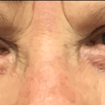 Blepharoplasty Before & After Patient #1835