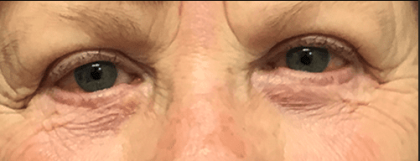 Blepharoplasty Before & After Patient #1835