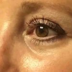 Blepharoplasty Before & After Patient #1838