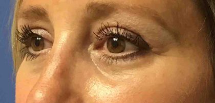 Blepharoplasty Before & After Patient #1838
