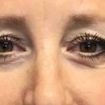 Blepharoplasty Before & After Patient #1838