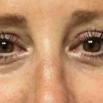 Blepharoplasty Before & After Patient #1838