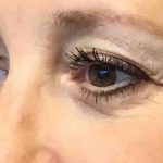 Blepharoplasty Before & After Patient #1838