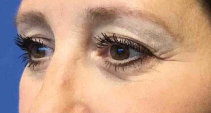 Blepharoplasty Before & After Patient #1838