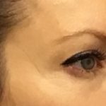 Blepharoplasty Before & After Patient #1843